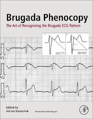 Brugada Phenocopy