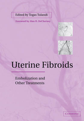 Uterine Fibroids