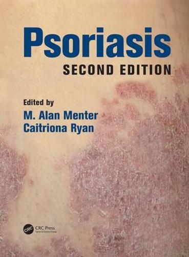 Psoriasis