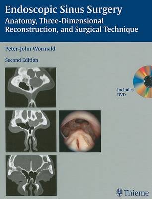 Endoscopic Sinus Surgery