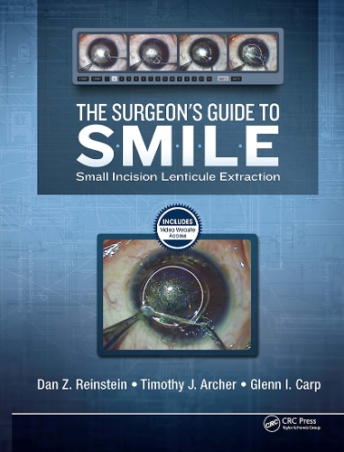 The Surgeon’s Guide to SMILE