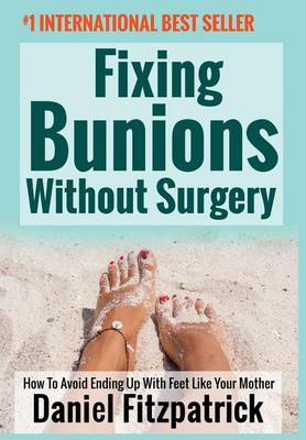 Fixing Bunions Without Surgery