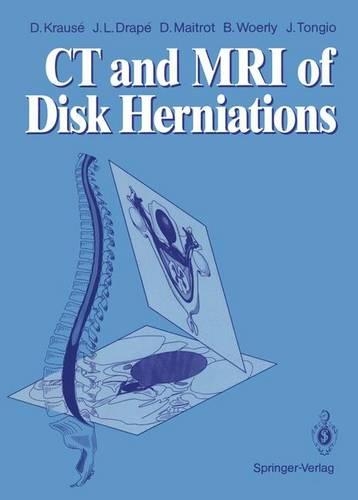 Computed Tomography and Magnetic Resonance Imaging of Disc Herniations