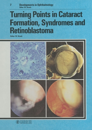 Turning Points in Cataract Formation, Syndromes and Retinoblastoma