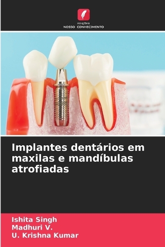 Implantes dentários em maxilas e mandíbulas atrofiadas