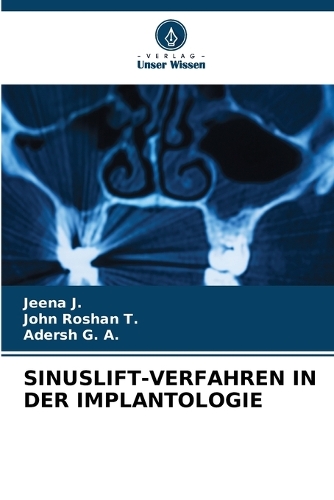 Sinuslift-Verfahren in Der Implantologie