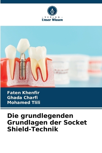 Die grundlegenden Grundlagen der Socket Shield-Technik
