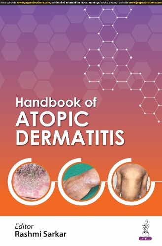 Handbook of Atopic Dermatitis