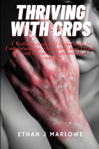 Thriving With CRPS