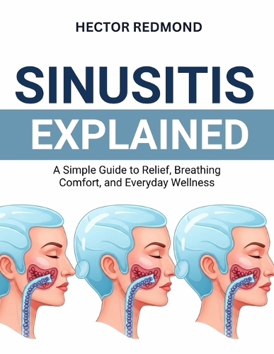 Sinusitis Explained