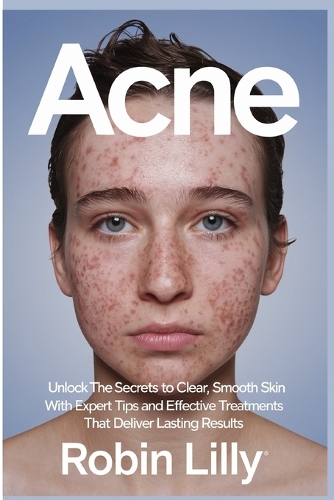 Acne