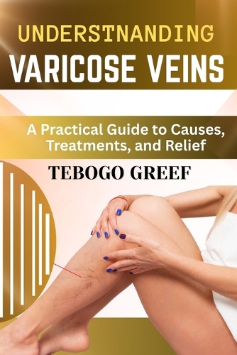 Understnanding Varicose Veins