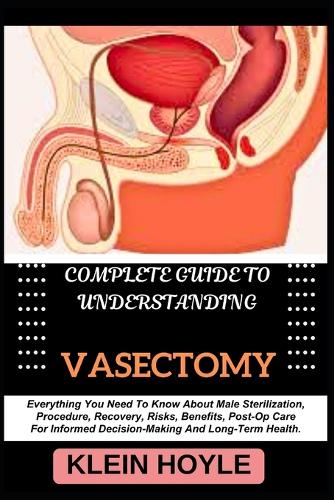 Complete Guide to Understanding Vasectomy