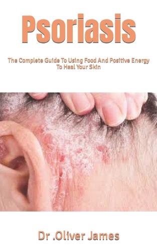 Psoriasis
