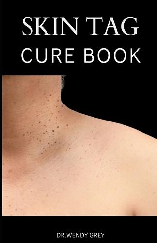 The Skin Tag Cure Book
