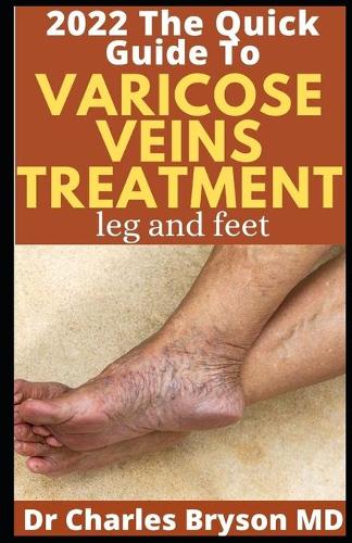 The Quick Guide To Varicose Veins Treatment (legs and feet)