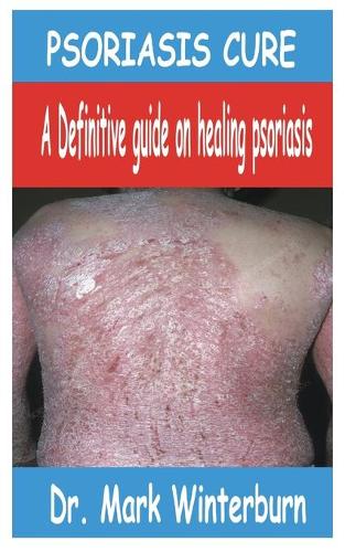 Psoriasis Cure