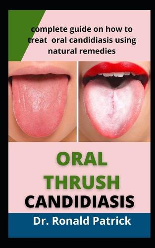 Oral Thrush Candidiasis
